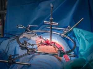 Unikátní meziobratlový implantát, který vymyslel olomoucký primář, už úspěšně pomáhá pacientům
