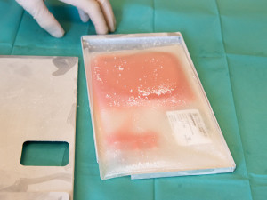 Transplantace kostní dřeně může být jedinou možností pro pacienty se závažnou poruchou krvetvorby