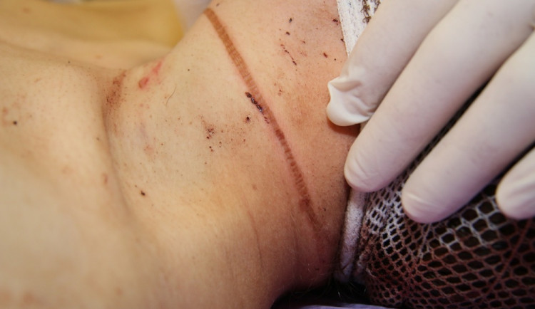 Stopa škrtidla na krku mladého bezdomovce, kterého napadl jeho jedenatřicetiletý spolubydlící ze stanu