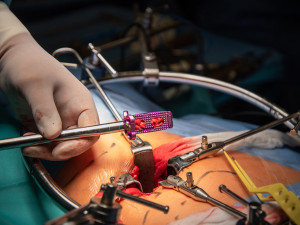 Titan, vanad a hliník: jedinečný meziobratlový implantát z Olomouce pomáhá pacientům už pět let
