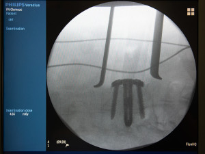 Titan, vanad a hliník: jedinečný meziobratlový implantát z Olomouce pomáhá pacientům už pět let