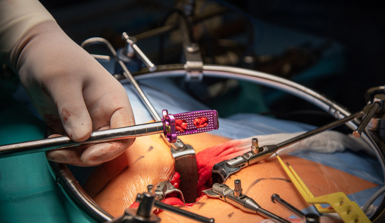Titan, vanad a hliník: jedinečný meziobratlový implantát z Olomouce pomáhá pacientům už pět let