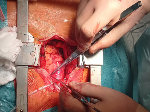 Místo chlopně bezstehová bioprotéza. Kardiochirurgové z FN Olomouc léčí srdeční vadu modernější metodou