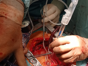 Místo chlopně bezstehová bioprotéza. Kardiochirurgové z FN Olomouc léčí srdeční vadu modernější metodou