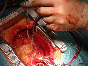 Místo chlopně bezstehová bioprotéza. Kardiochirurgové z FN Olomouc léčí srdeční vadu modernější metodou