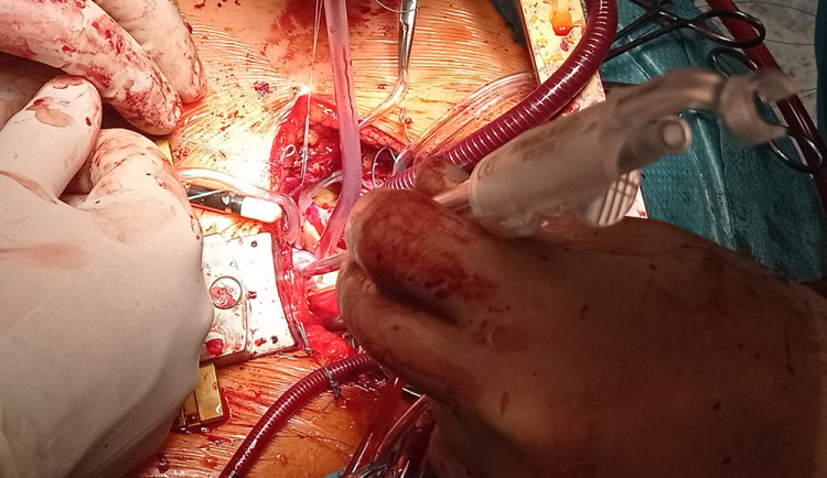 Místo chlopně bezstehová bioprotéza. Kardiochirurgové z FN Olomouc léčí srdeční vadu modernější metodou