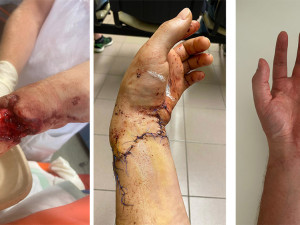 2 - Ruka visela už jen na kousku zápěstí. Díky specialistům z FN Olomouc může mladý hasič opět pomáhat v nouzi