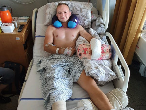 4 - Ruka visela už jen na kousku zápěstí. Díky specialistům z FN Olomouc může mladý hasič opět pomáhat v nouzi