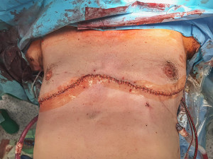 3 - Kovová tyč probodla při pádu muži z Přerovska obě plíce