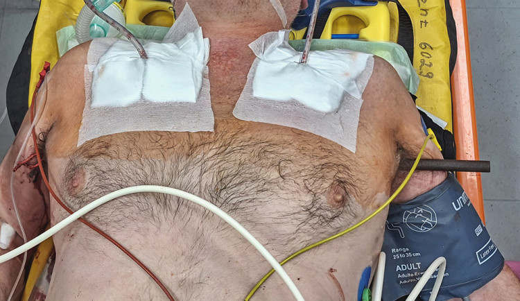 Kovová tyč probodla při pádu muži z Přerovska obě plíce