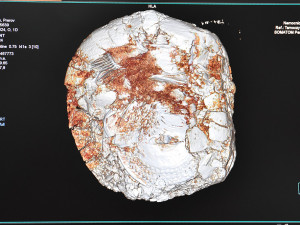 CT přístroj v přerovské nemocnici pomohl archeologům. Odtajnil cenný obsah tři tisíce let staré nádoby