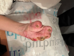 Streptokok ho připravil o prsty i část nohy, bojovník Mareček ale bitvu o život ve FN Olomouc vyhrál