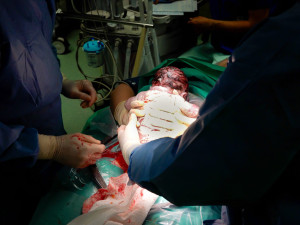 Miminko si maminka vytáhla sama. Denisa v šumperské porodnici prožila laskavý císařský řez