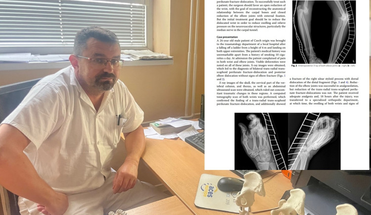 Muž si vykloubil obě zápěstí a oba lokty. Operace na Vysočině byla světovou raritou