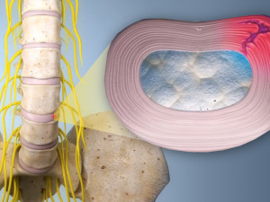 Bolest zad nemusí omezovat. Řešení můžete najít v EuroPainClinics Olomouc