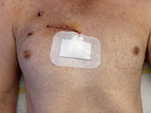 Šetrná výměna chlopně. Lékaři z Olomouce představili moderní operační metodu