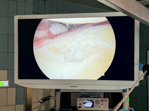 Bolí vás rameno? Lékaři z Olomouce mají novou metodu na léčbu poškozené chrupavky