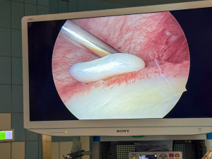 Bolí vás rameno? Lékaři z Olomouce mají novou metodu na léčbu poškozené chrupavky