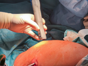 Bolí vás rameno? Lékaři z Olomouce mají novou metodu na léčbu poškozené chrupavky