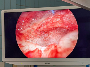 Bolí vás rameno? Lékaři z Olomouce mají novou metodu na léčbu poškozené chrupavky