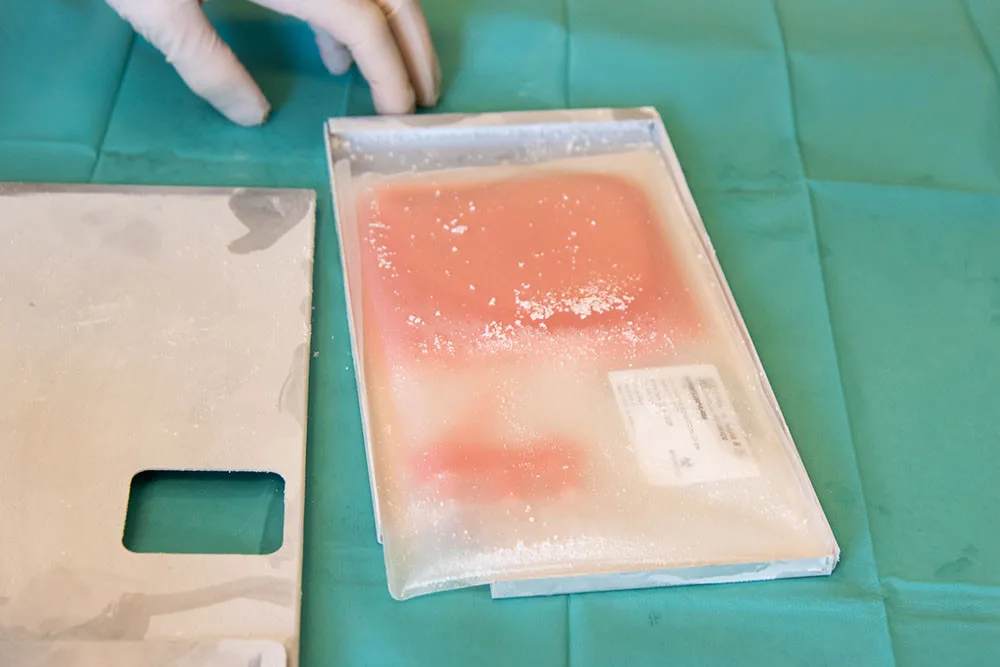 Transplantace kostní dřeně může být jedinou možností pro pacienty se závažnou poruchou krvetvorby