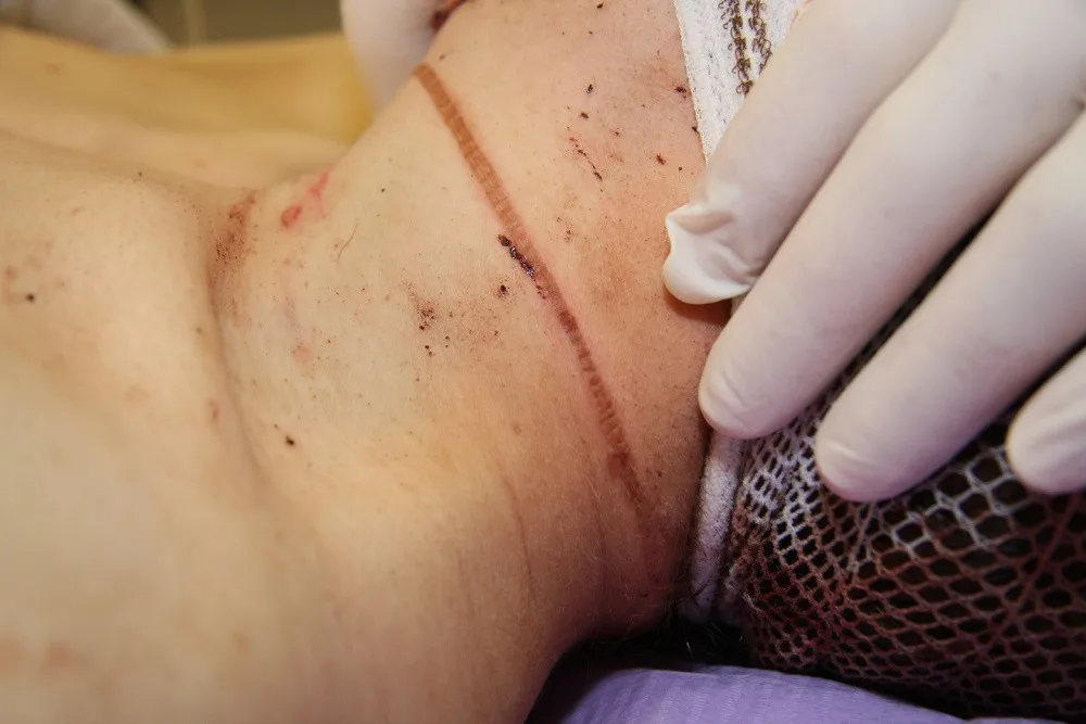 Stopa škrtidla na krku mladého bezdomovce, kterého napadl jeho jedenatřicetiletý spolubydlící ze stanu