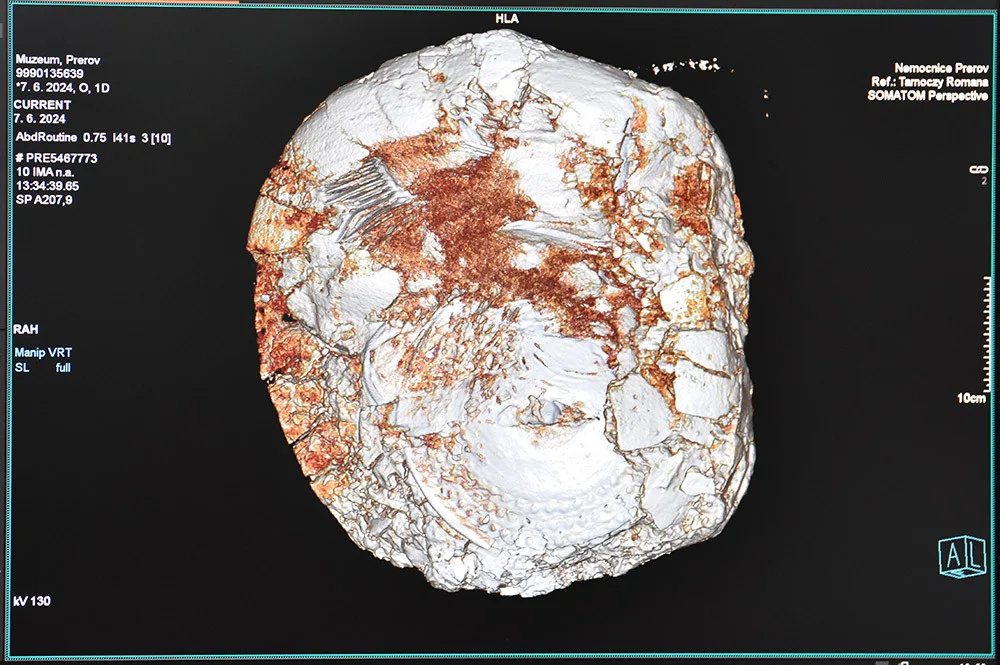 CT přístroj v přerovské nemocnici pomohl archeologům. Odtajnil cenný obsah tři tisíce let staré nádoby