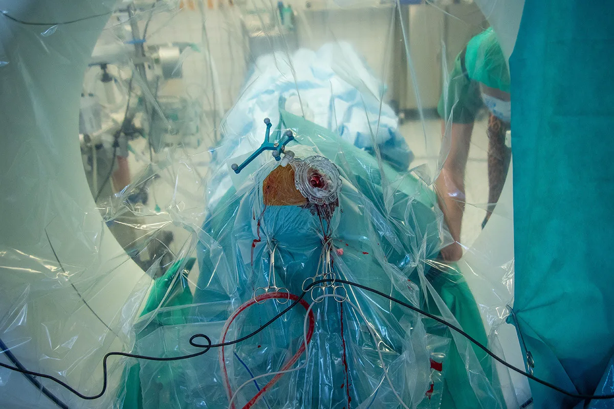 Neurochirurgická operace psychiatrického pacienta ve FN Olomouc