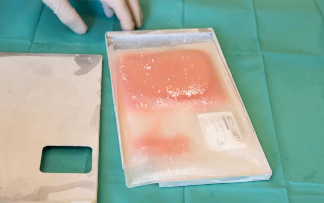 Transplantace kostní dřeně může být jedinou možností pro pacienty se závažnou poruchou krvetvorby