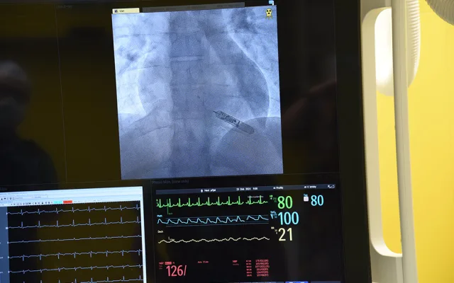 Olomoučtí kardiologové poprvé implantovali pacientovi biomonitor využívající AI. Hlídá srdce mladého řidiče