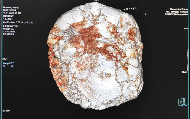 CT přístroj v přerovské nemocnici pomohl archeologům. Odtajnil cenný obsah tři tisíce let staré nádoby