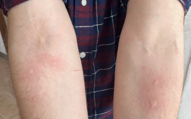 Na jarní alergie platí procházky po dešti, odborníci radí i další fígle