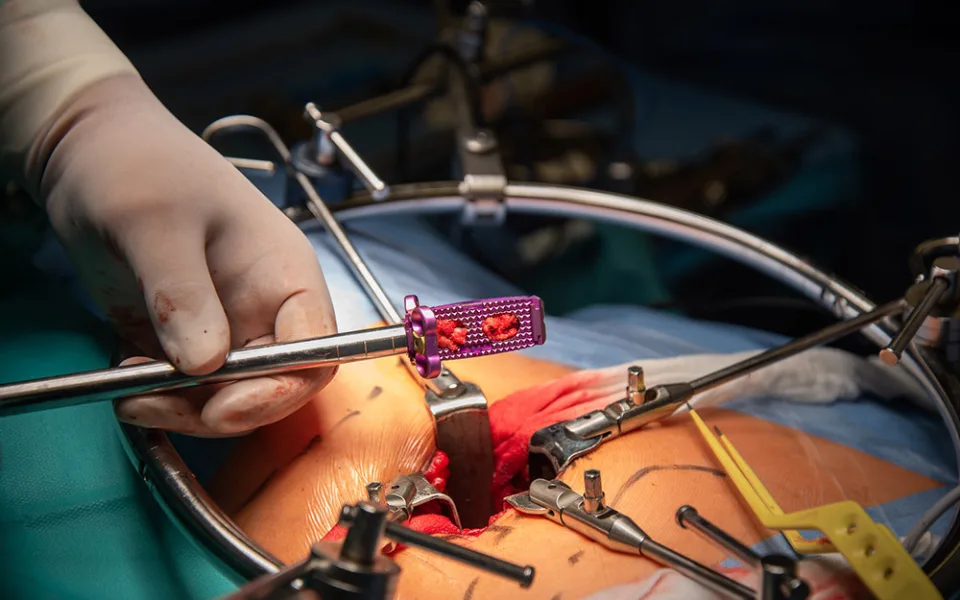 Titan, vanad a hliník: jedinečný meziobratlový implantát z Olomouce pomáhá pacientům už pět let
