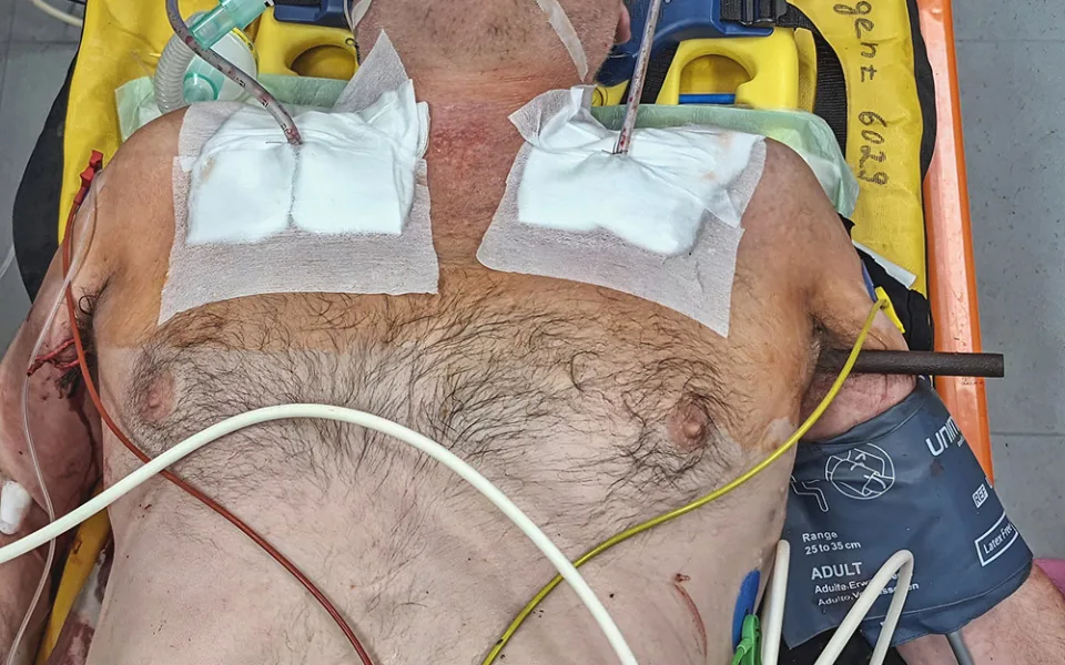 Kovová tyč probodla při pádu muži z Přerovska obě plíce